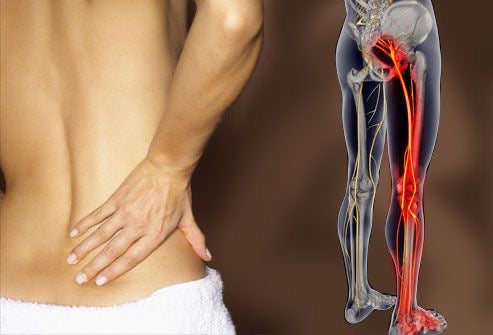 8-week Sciatica-focused exercise program