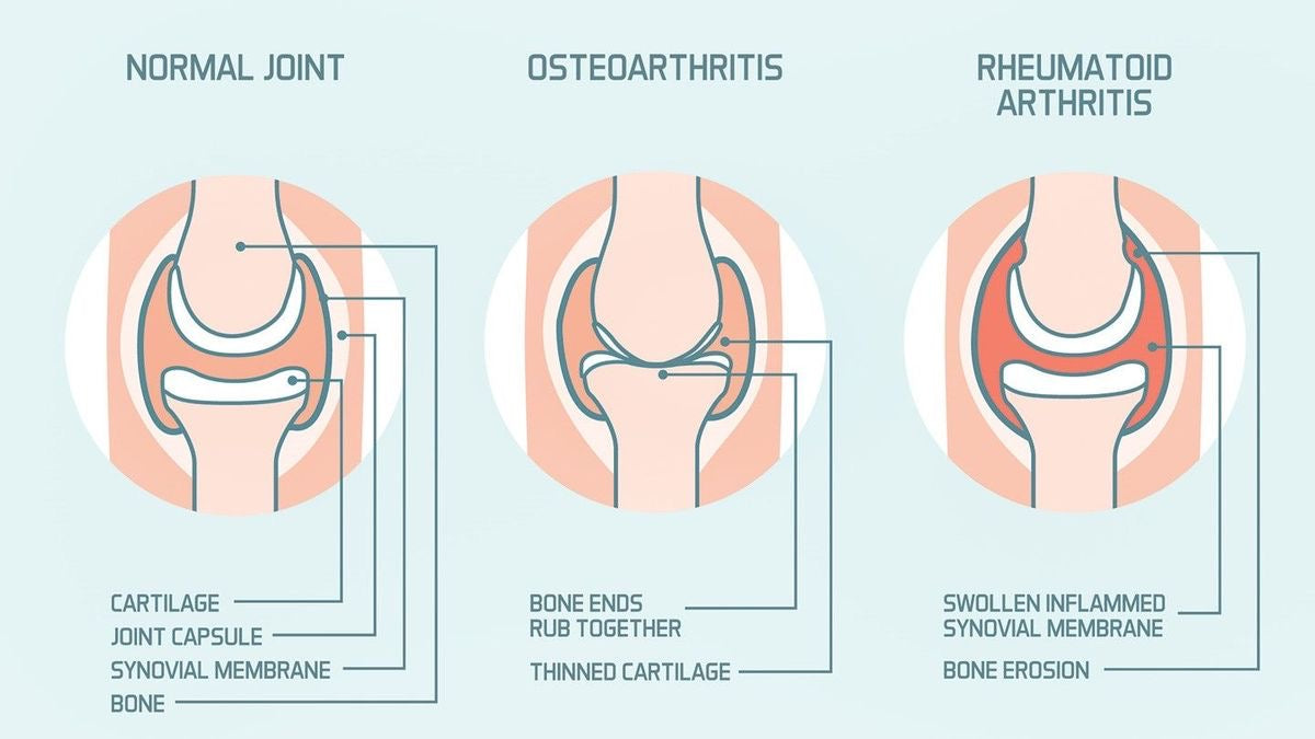 8-week Arthritis-focused exercise program