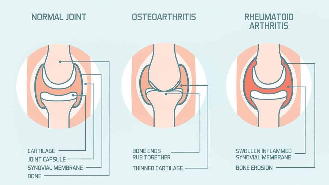 What is Arthritis? And the Do’s and Don’ts with Exercise
